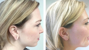 Rediscovering Earlobe Beauty With Surgery