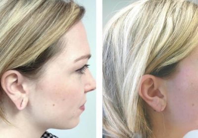 Rediscovering Earlobe Beauty With Surgery