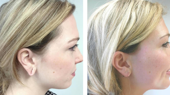 Rediscovering Earlobe Beauty With Surgery
