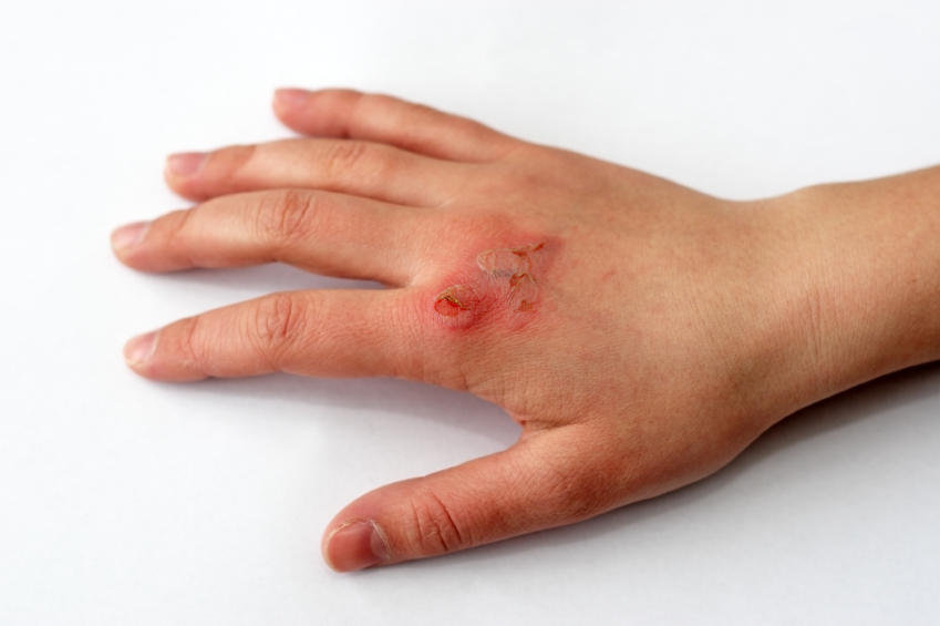 Your Best Guide To Claiming Compensation For A Burn Injury