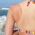 6 Sunburn Remedies For Fast Relief