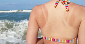 6 Sunburn Remedies For Fast Relief